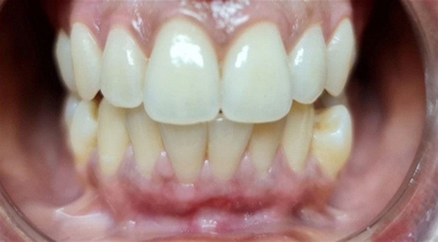 بعد تجميل وعلاج اللثة مركز دكتور ايمن الغمراوى لطب الاسنان 7